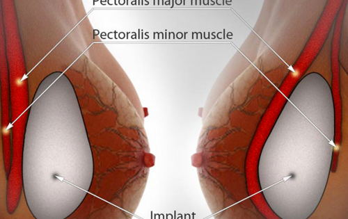 Фитнес тренировки след мастектомия и поставяне на гръдни импланти подмускулно | Жени
