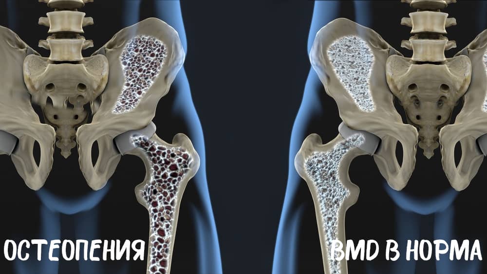 osteopenia_dieta_fitness_dobavki_2